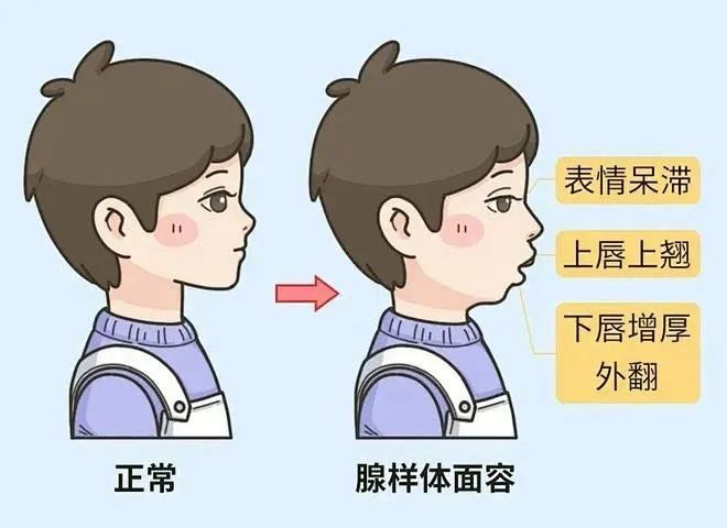 腺样体面容.jpg